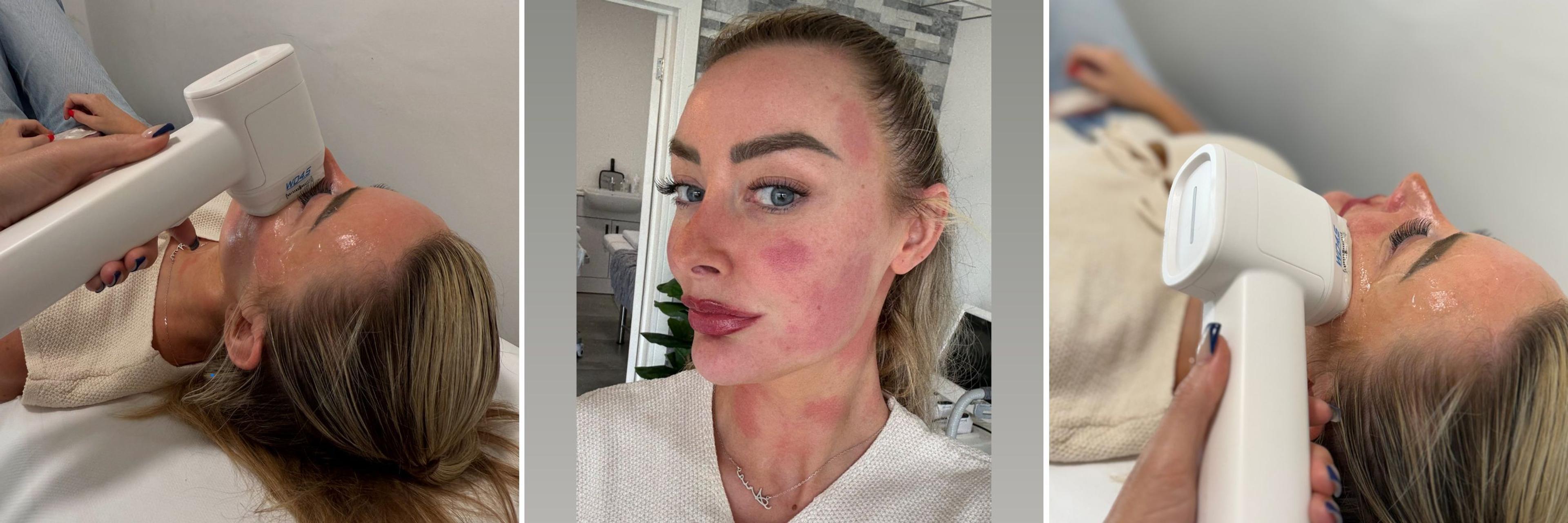 Cover image for Chloe Crowhurst HIFU South Yorkshire (1)