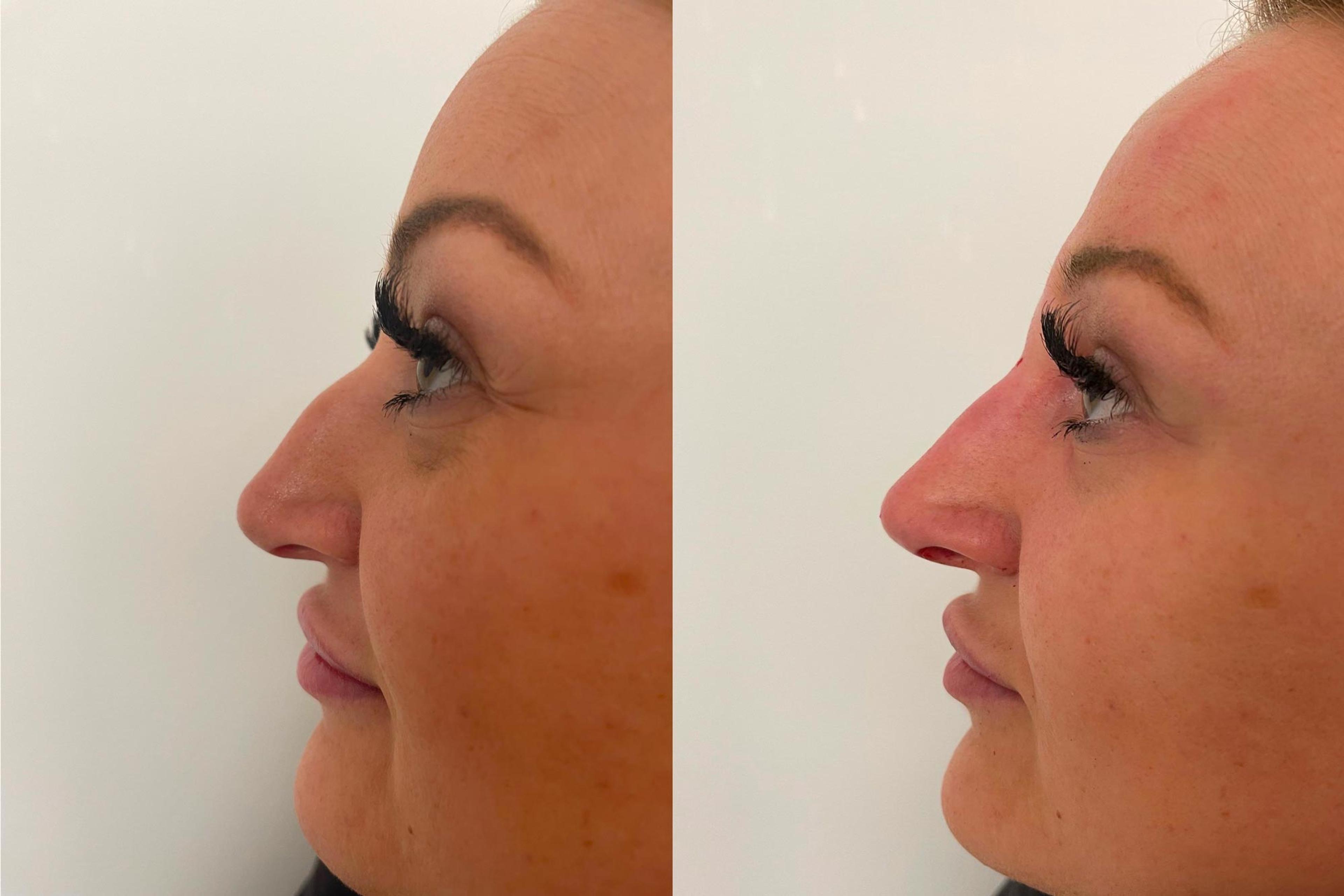 Non surgical rhinoplasty treatment South Yorkshire