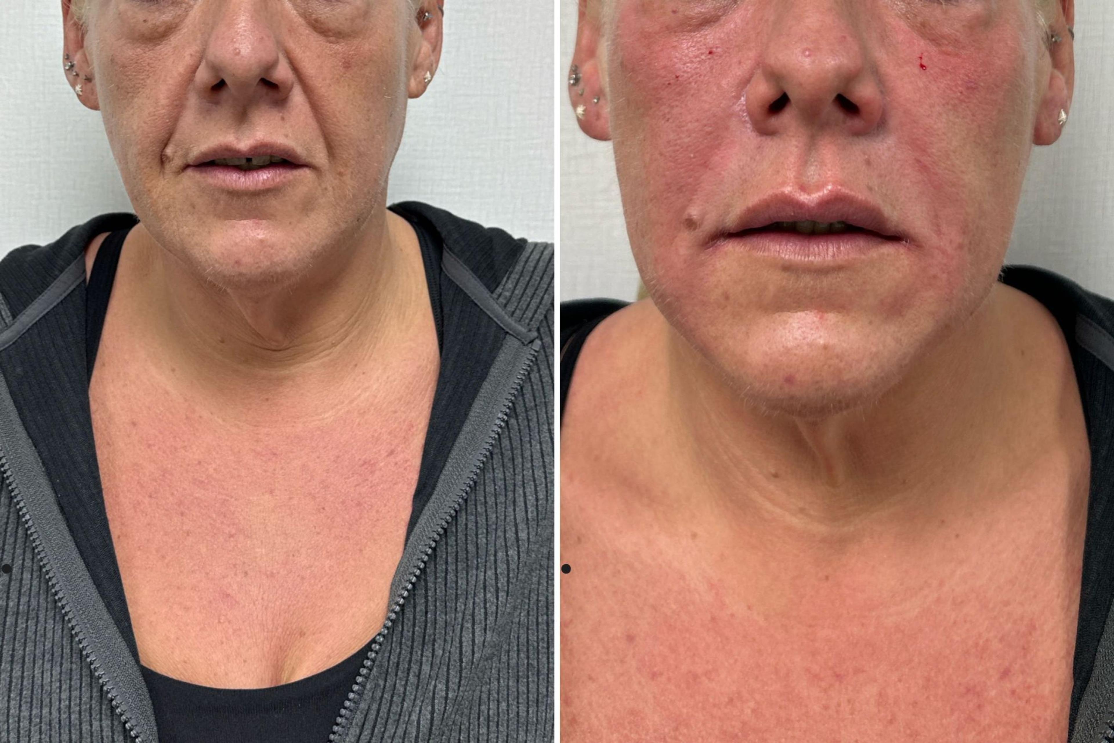 Cover image for Marionette Line Treatment Using Dermal Fillers in South Yorkshire