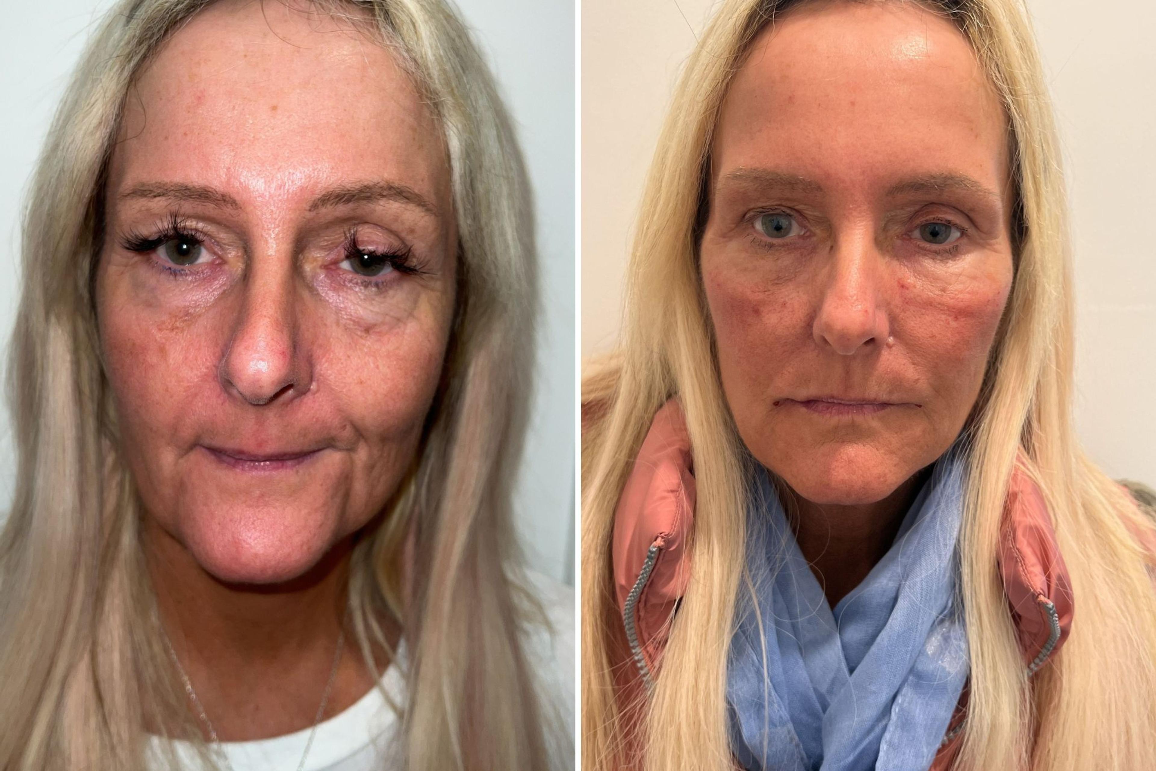 Tear trough filler treatment South Yorkshire.