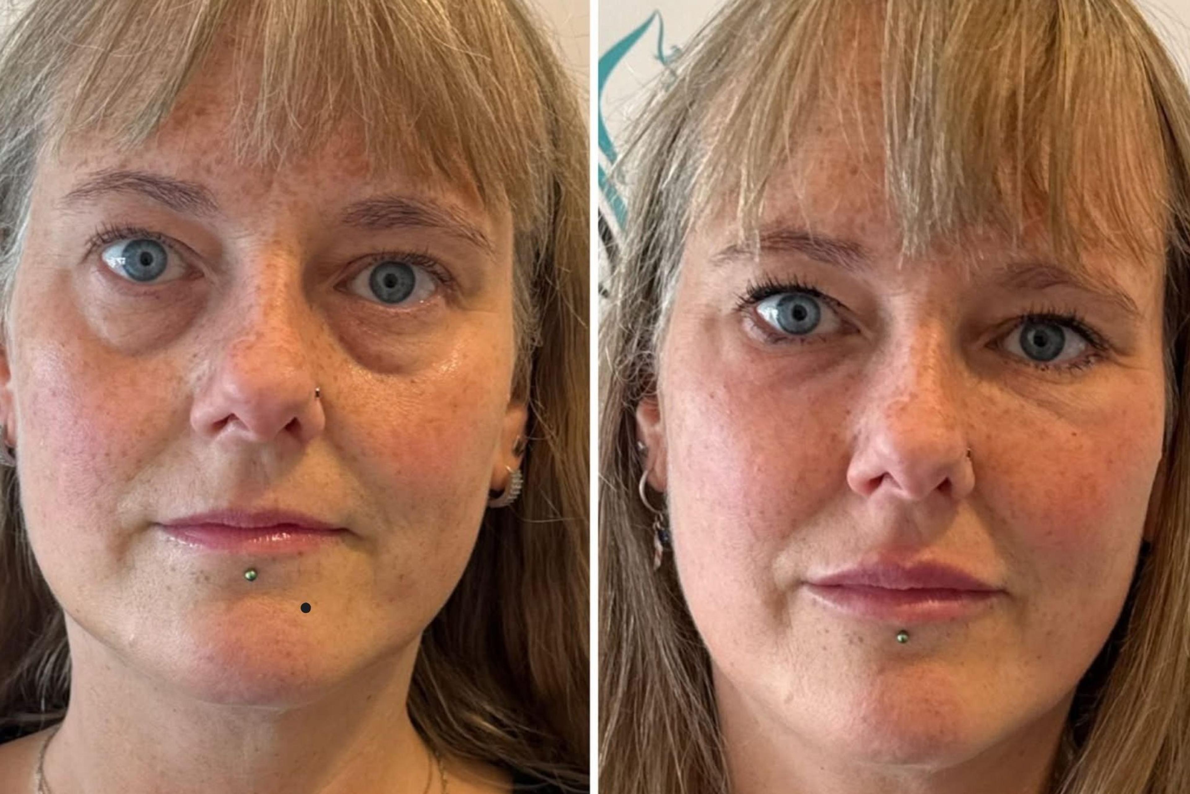 Cover image for Under Eye Filler Treatment in South Yorkshire