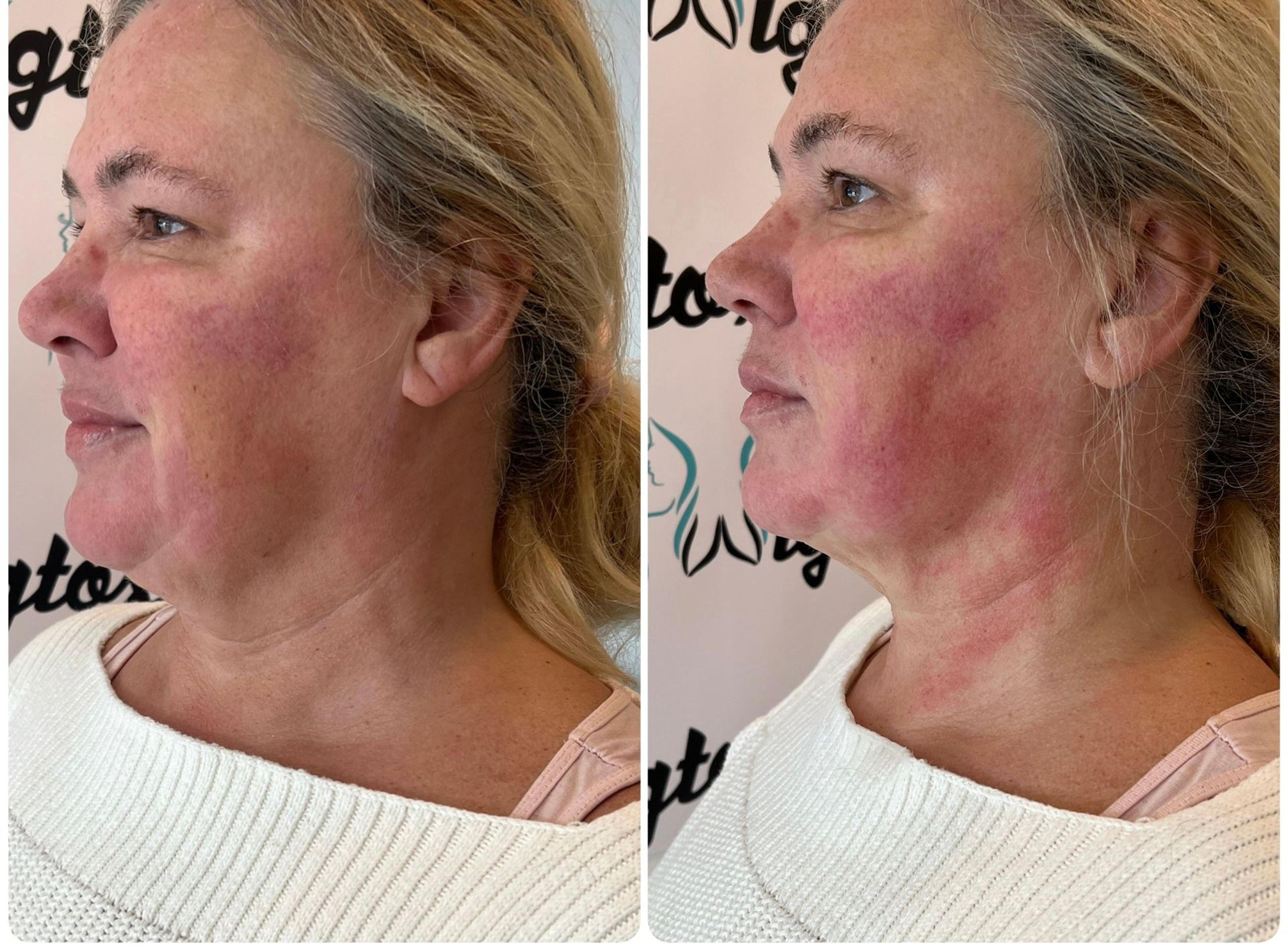 Cover image for 5D HIFU at Wigtox South Yorkshire