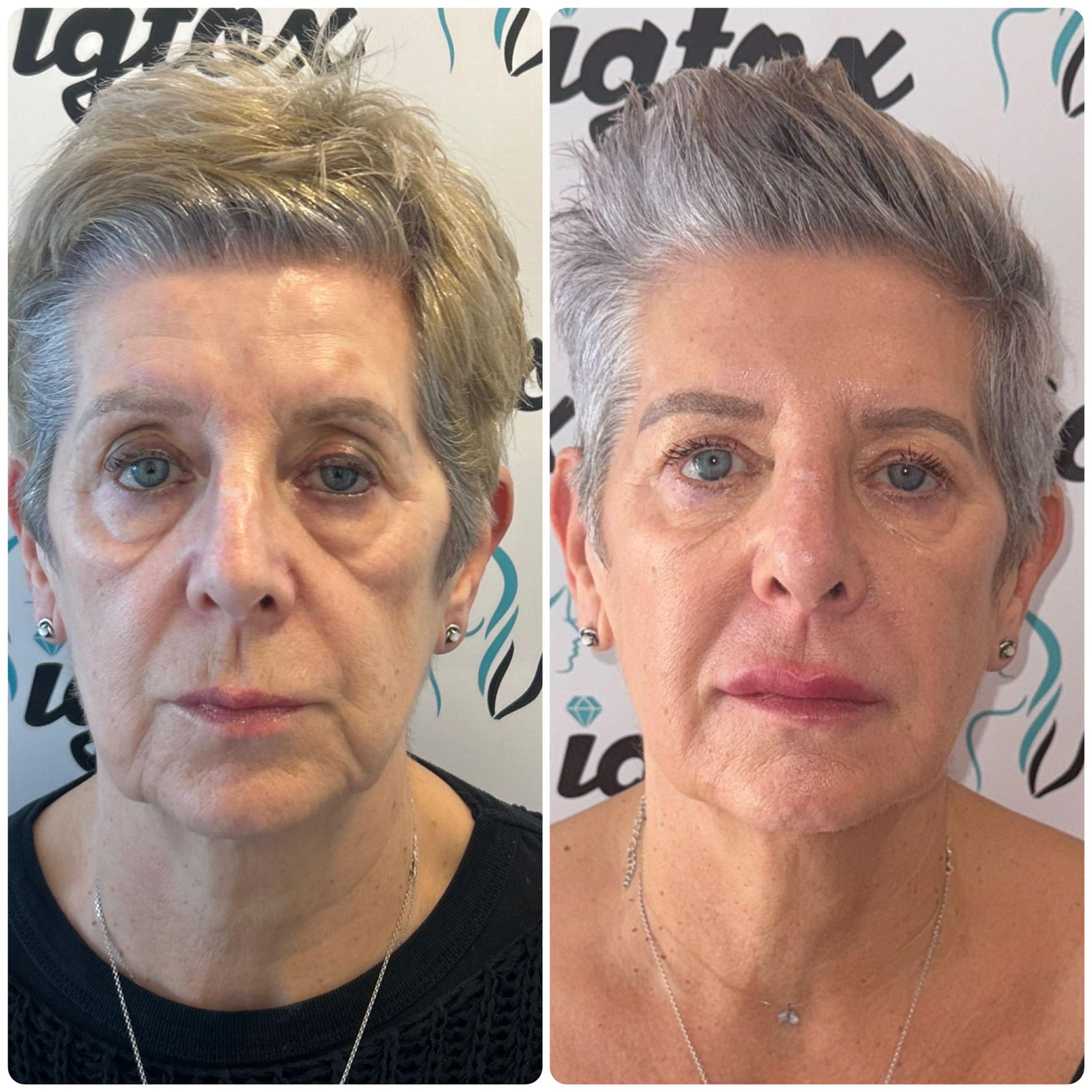 Cover image for No More Lines with Fillers at Wigtox South Yorkshire (1)