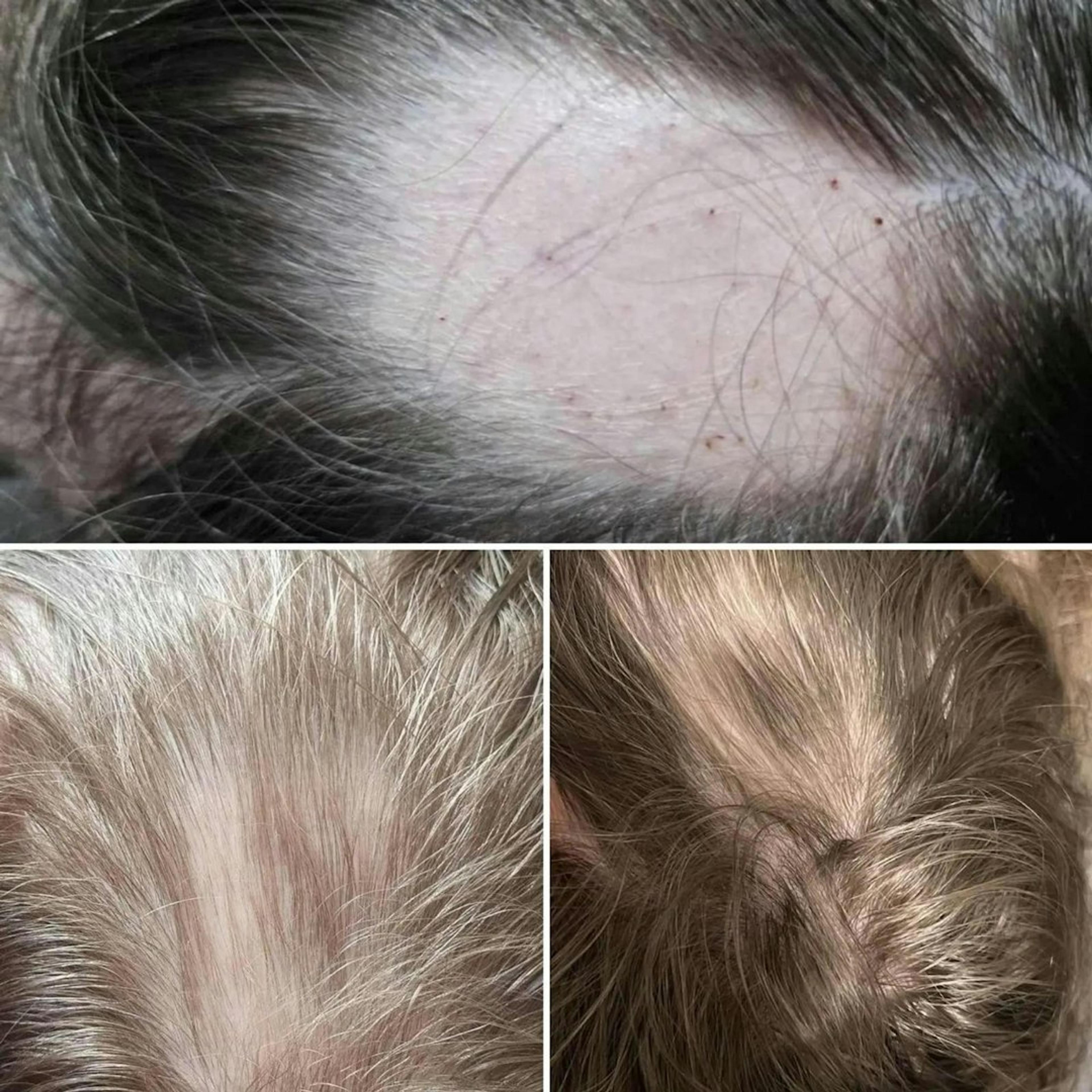 Cover image for Hair regrowth treatment with PRP hair treatment